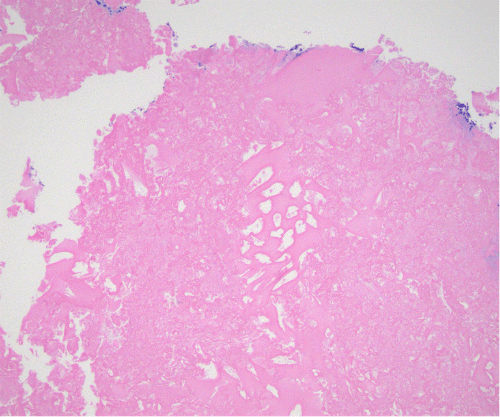 This image demonstrates a foreign body reaction (entrapped histiocytes) to acellular, eosinophilic material (oxidized cellulose). Note the presence of fibrinous and/or necrotic debris alongside areas of sheet-like deposits and cystic spaces. Clinicopathologic correlation confirmed the material as residual Surgicel® from the preceding surgery.