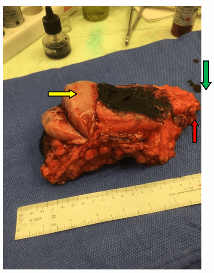 Figure 2. B: Incised tumor with inked, deep margin (muscle fascia). The sarcoma is well encapsulated, smooth, and lighter in color than the surrounding lobulated yellow fat. Yellow arrow marks incised tumor capsule with sarcoma bulging, green arrow marks inferior resection margin, red arrow marks inferior tied edge of the great saphenous vein.