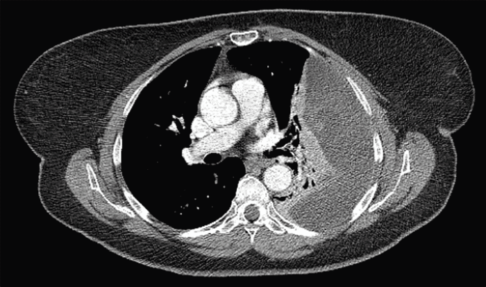 Preoperative CT of the chest demonstrating a large heterogeneous left pleural effusion with internal septations, suggestive of loculation