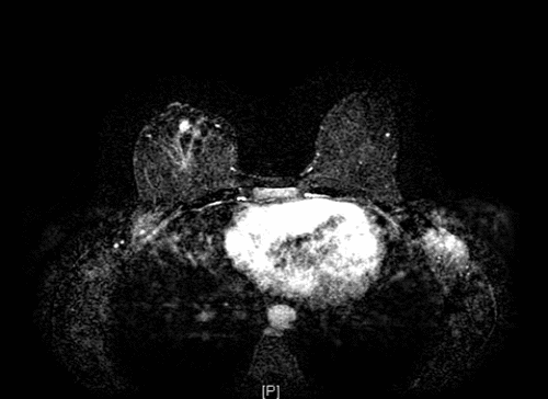 A) Axial cut of right breast
