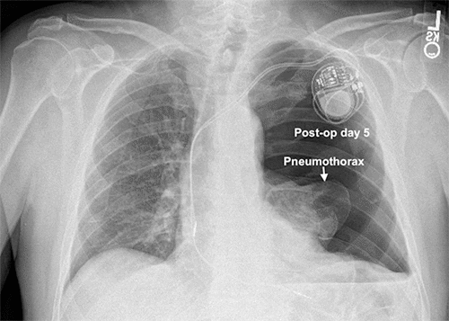 Appearance after five nights of continuous positive airway pressure (CPAP) therapy. Note left-to-right mediastinal shift; still, patient had normal vitals.