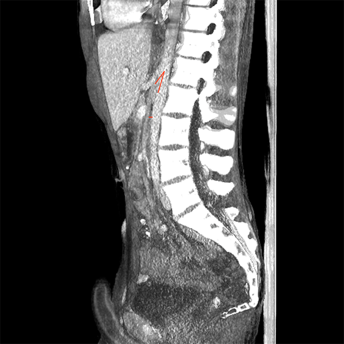 Figure 2. CT with intravenous contrast of the abdomen and pelvis. A sagittal reconstruction demonstrates a narrowed aortomesenteric angle measuring 20.5˚ and reduced aortomesenteric distance measuring 3.3mm, both marked.