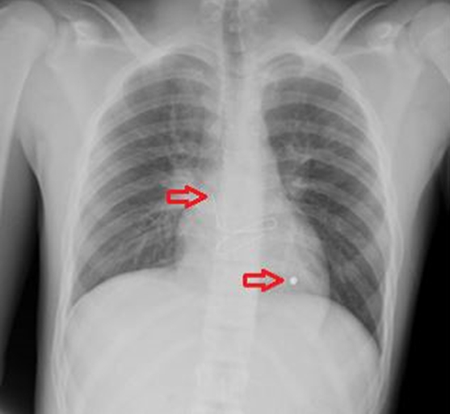 Figure 1. Arrows pointing to entrance wound marked with a clip and foreign body inside the cardiac silhouette. 