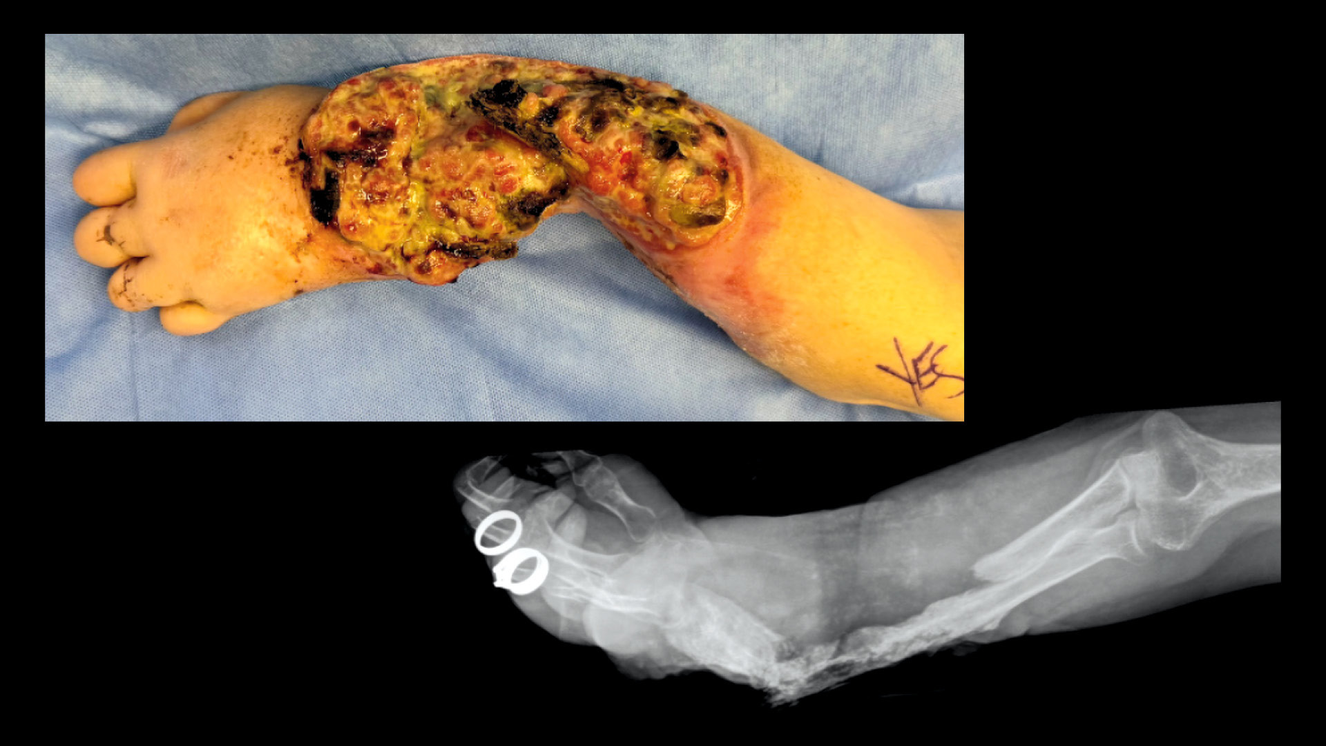This photograph and radiographic image show a forearm with severe xylazine wounds and related osteomyelitis and bone fracture.