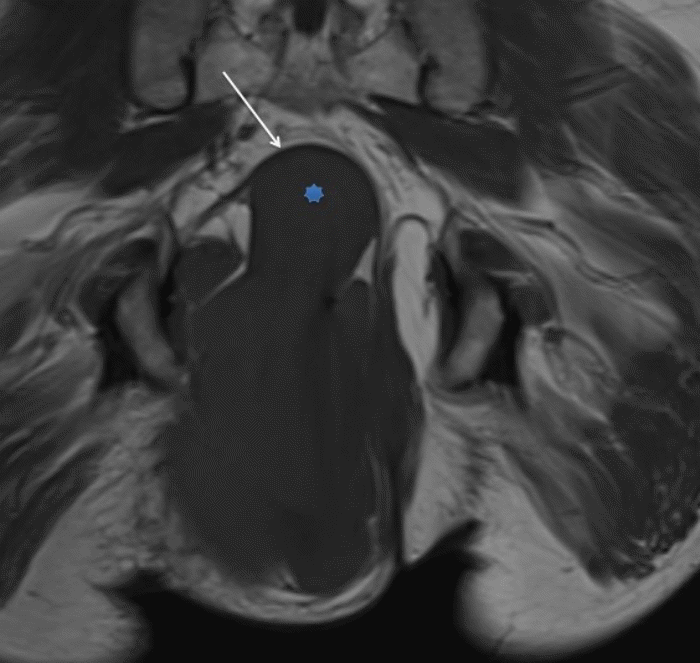 The large pelvic neurofibroma (asterisks) causes an abutment of the urethra (white arrow)
