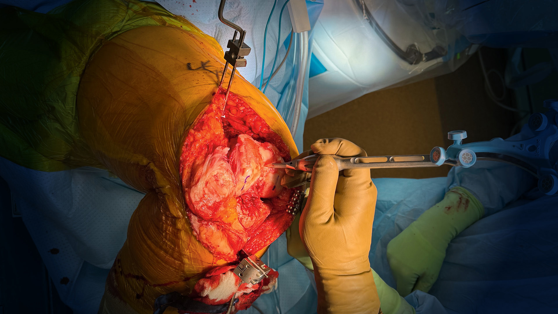 Robotics Help Improve Precision, Personalization of Knee Replacement Surgery