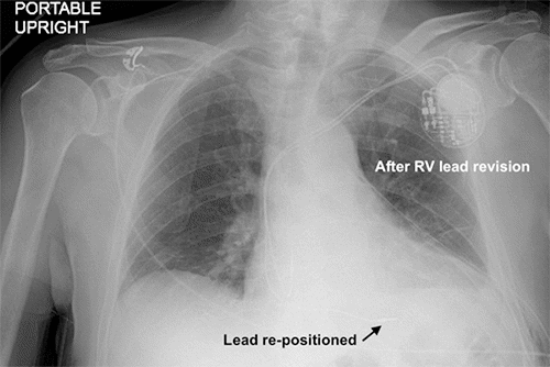 Left chest tube is still in place, and there is no evidence of pneumothorax