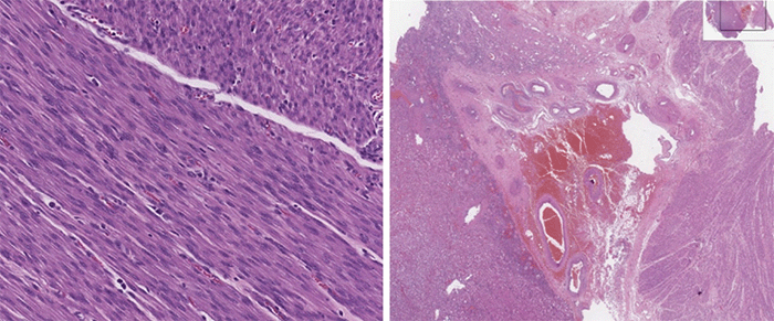 Immunohistochemical profile positive for desmin, WT1, PR (ER patchy); negative for HMB45, pan-melanoma, MDM2 amplification