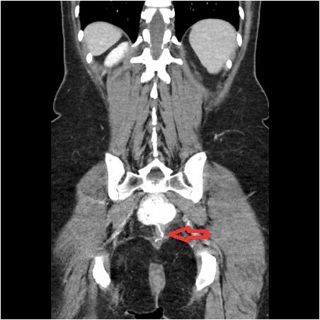 Figure 3. Arrow noting distal pouch narrowing with proximal dilation due to torsion (2018)